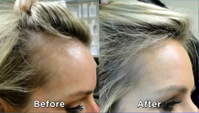 Women Hair Loss