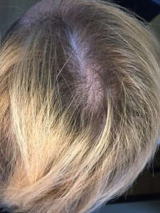 PRP with ACell - 5 months after - Top of Head